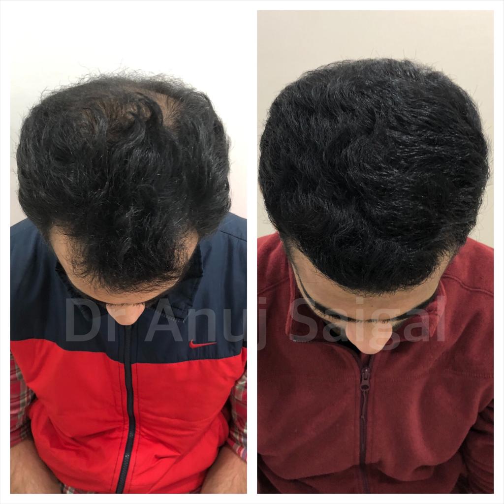 Best Hair Transplant clinic in delhi